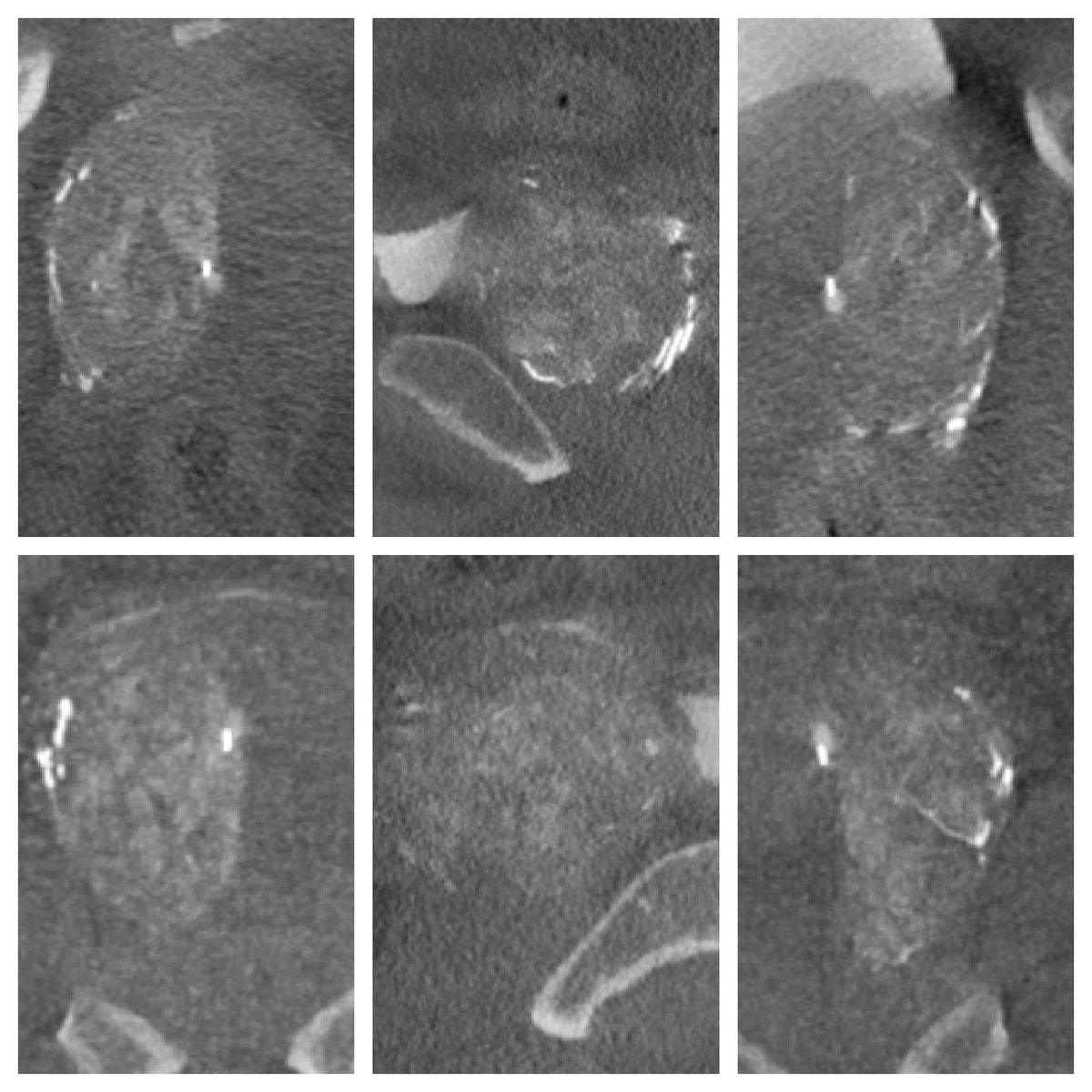 Safet_MD's tweet photo. #PAE for #BPH @OBL. Patient weeks out feeling great! #Prostate. #irad #EmboAssist @ImagingDoctor @WindsongRad @SIR_ECS @SIRRFS @kmadass @arslanmd @bonesz @SandeepBaglaMD @AriIsaacsonMD @keithppereira @IR_Nutt @p_oconnor1 @IRAngioClub @GEHealthcare @StevenZerbo @UBUrology #cbct https://t.co/4ON1rmWhxN