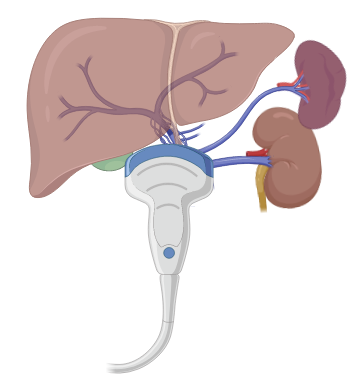 (1/ )There has been an overwhelming interest in the use of hepatic waveforms as a congestive parameter. With social media, somewhat obscure concepts like these are quickly brought to the forefront and implemented in clinical practice. Many are eager to incorporate  #VEXUS but...