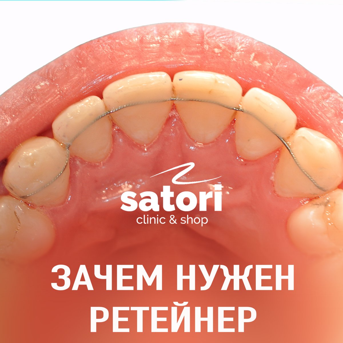 samarasatori's tweet photo. https://t.co/PbBP1CneF9
#стоматологсамара #стоматологиявсамаре  #брекетысамара #брекетывсамаре #красивыезубы #ортодонт #ортодонтсамара #braces #брекеты #брекетыдоипослесамара
#брекетысамара #ретенированныйзуб #диастема #стоматология #исправлениеприкуса https://t.co/roByZWl8nC