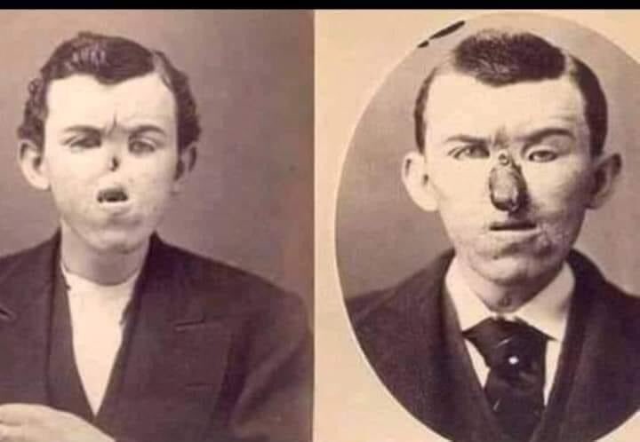 أول عملية تجميل في التاريخ قام بها طبيب أمريكي في مستشفى بنيويورك عام 1880 لرجل فقد أنفه في حادث ، حيث قام الطبيب باستبدال أنف الرجل الذي فقده بأحد أصابع يديه 
#عاده_صعب_تتركها