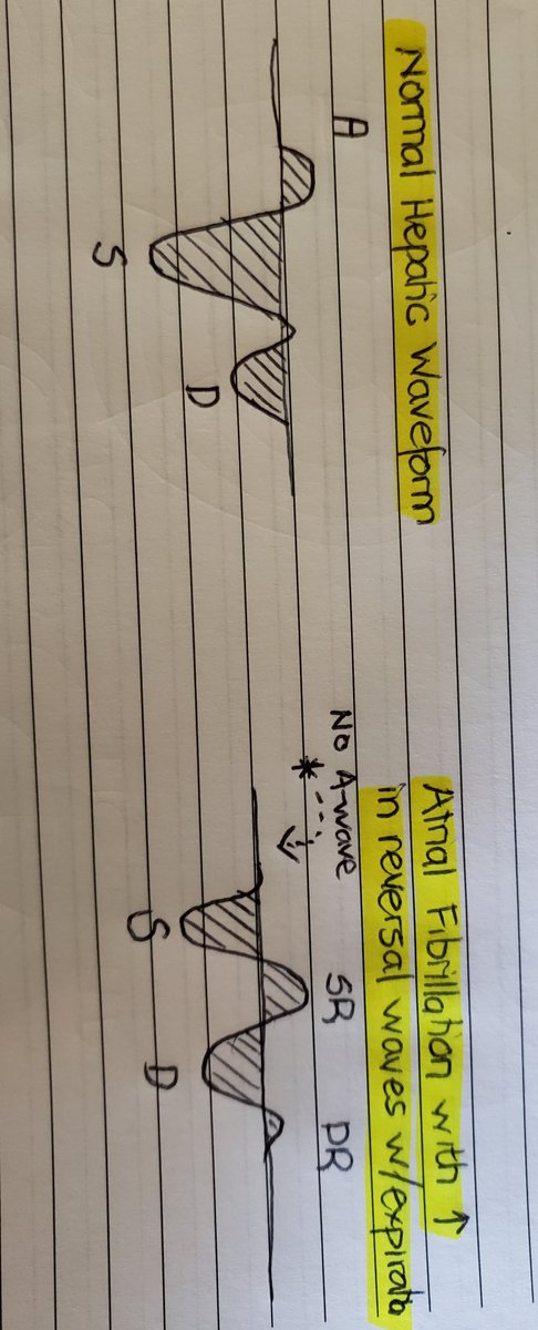 (8/13) Rule 2: **Timing of waveforms w/ cardiac cycle**“Systole? Diastole? Who cares! I’ve seen so many of these waves I don’t NO EKG leads.” Please don’t be that person. You can be easily misled if you don’t interpret in the context of timing of the cardiac cycle. See below..