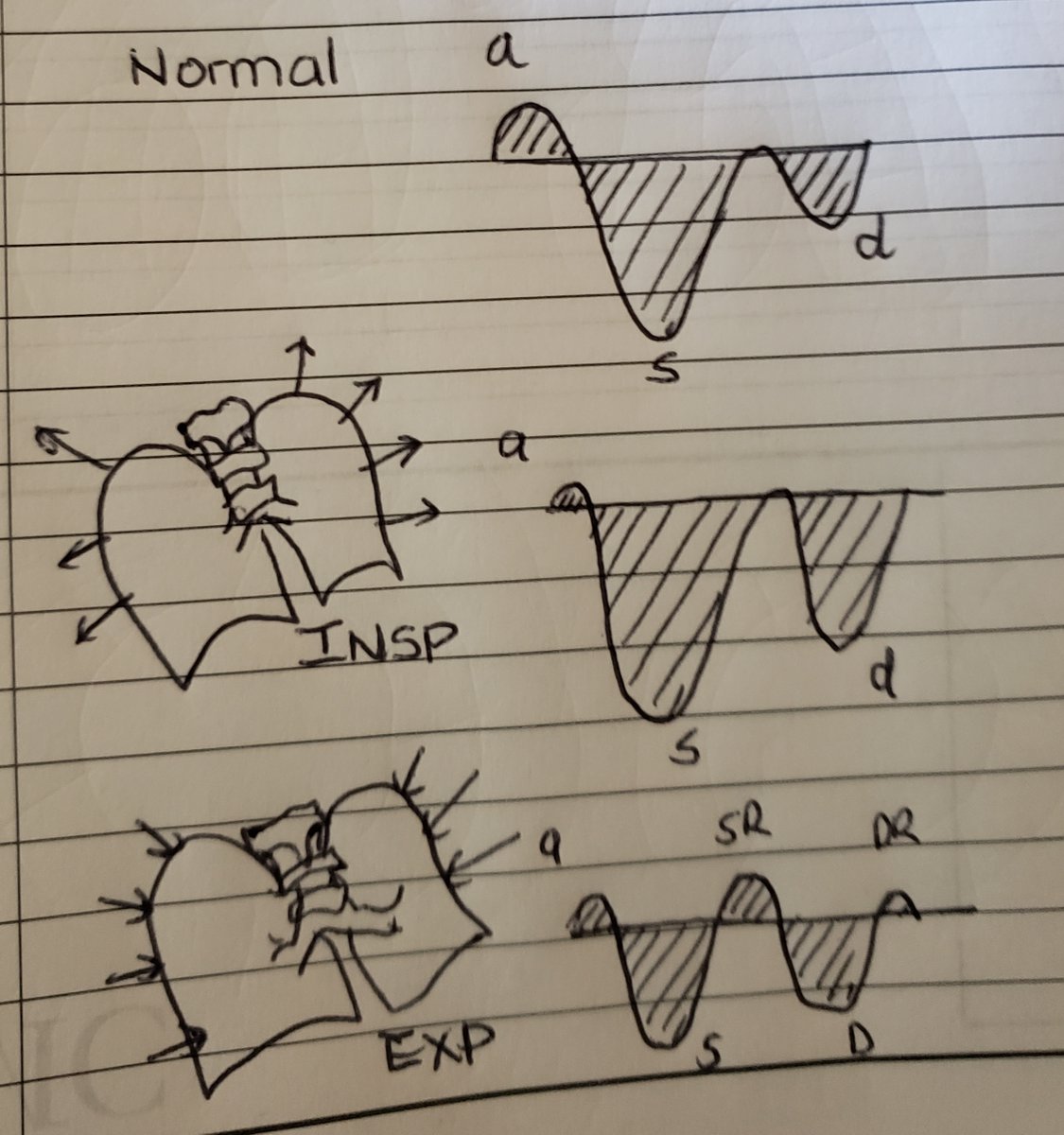 (10/13) Rule 4: ** Changes with Breathing **With inspiration antegrade flow (S and D waves increase), With expiration the reversal waves increase (SR and DR).