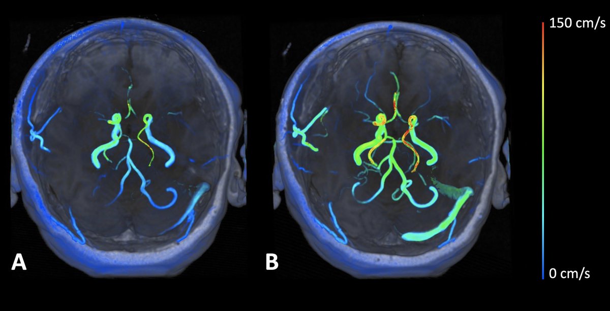 <a href="/NeurosurgUCSF/">UCSF Neurosurgery</a> <a href="/UCSF/">UC San Francisco</a> <a href="/calebcuts/">Caleb Rutledge</a> 4D flow phase contrast imaging during CVR testing demonstrates the bypass graft’s contribution to cerebrovascular reserve!