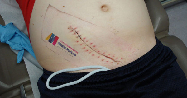 ChiguireBipolar's tweet image. «Ya no nos pueden quitar más nada» dice venezolano antes de que le quiten un riñón ow.ly/xZvg30qSrW3