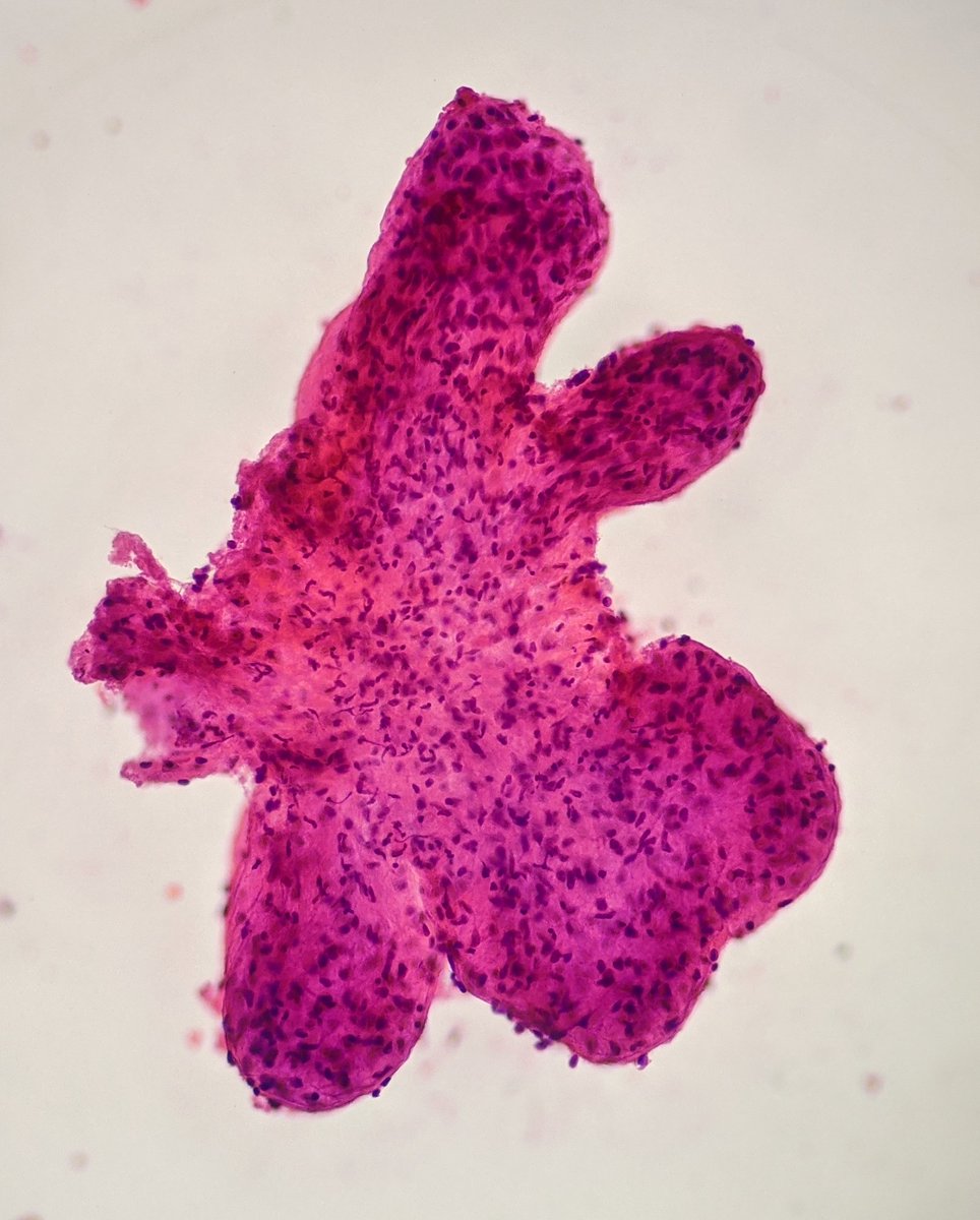 Leaf like pattern in Fibroepithelial Breast tumor., image size:964x1200