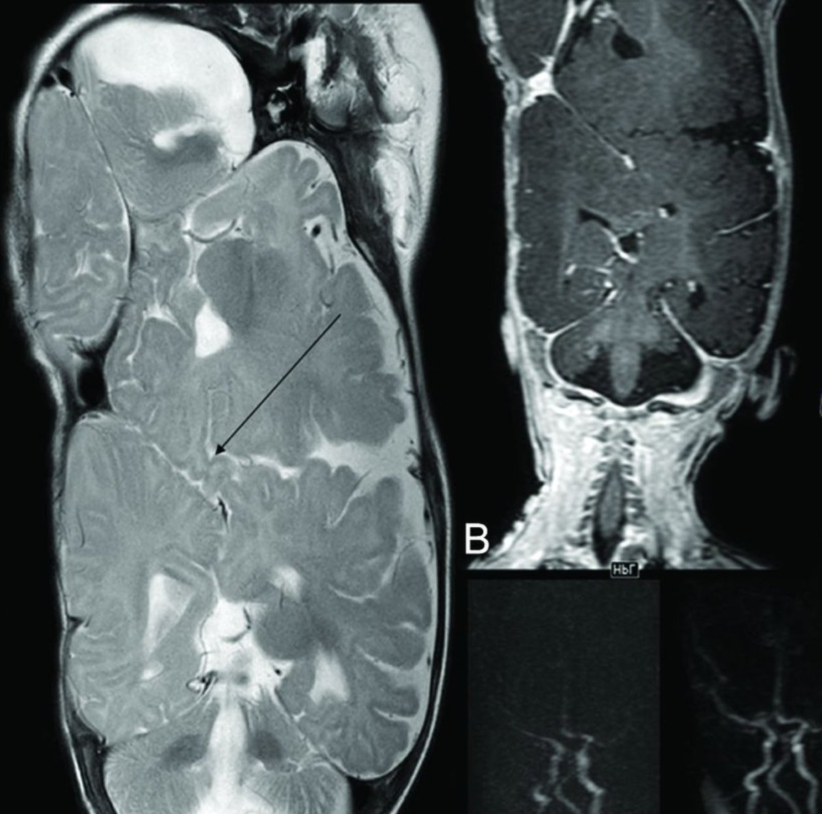 tl/dr: Understated but stunning review on imaging of twins connected at the *brain*
ajnr.org/content/early/…

discovered with <a href="/orbitcme/">Orbit CME</a> for <a href="/corephysics/">Core Physics Review</a>. Earn SAM for this article at orbitcme.com/radiology

#orbitcme #foamrad #neurorad #radres