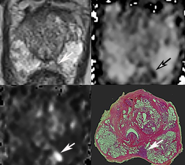 CornudF's tweet photo. The 1st International Workshop on Diagnostic of Prostate Cancer by multiparametric MRI and MRI-directed prostate biopsies for radiologists and urologists will be held online on Sept 24th and 25th. Program and registration available here: https://t.co/hx75fOS4Vp https://t.co/ziFPkenSht