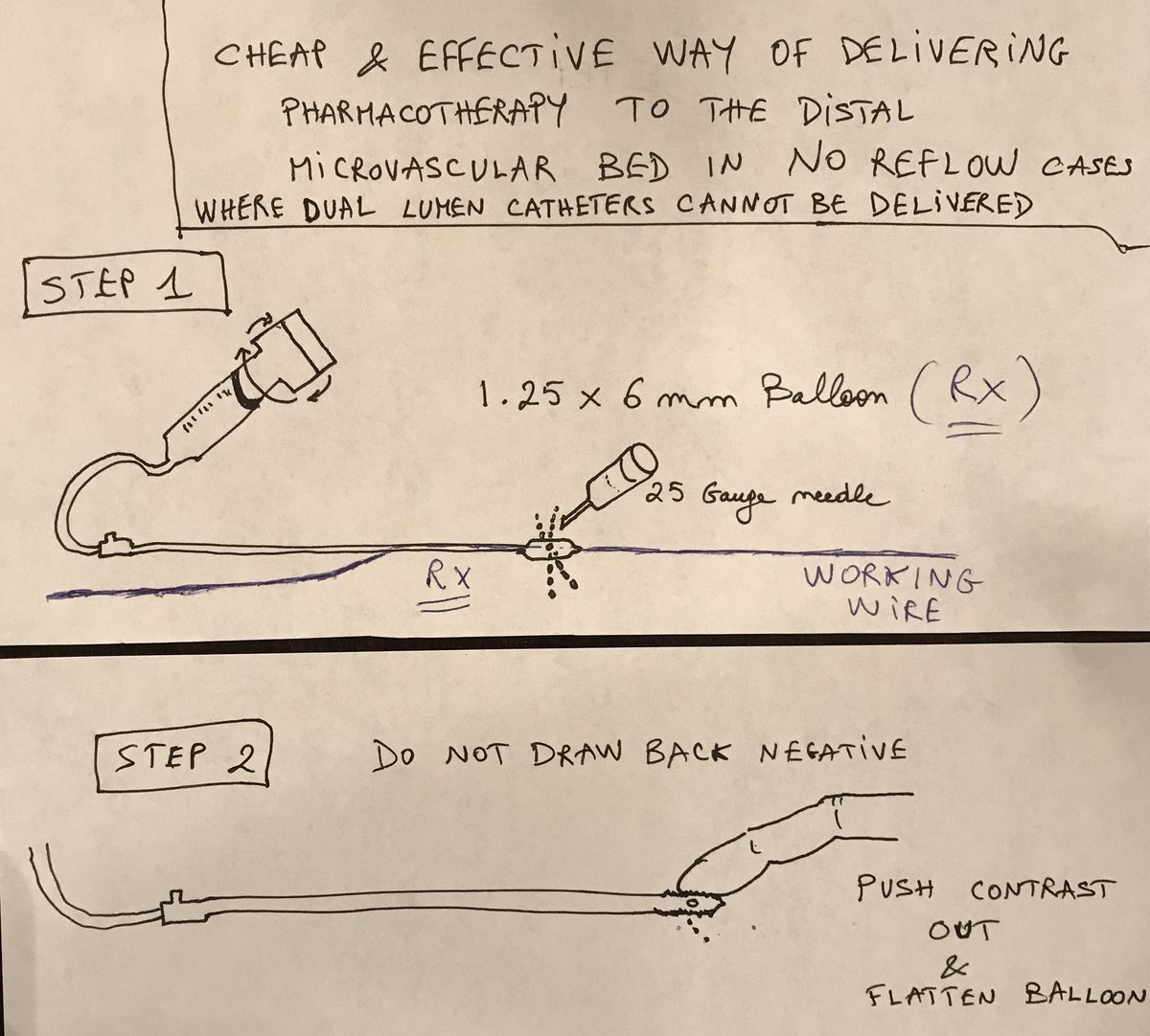 HadyLichaaMD's tweet image. #Cathlabhack: When dual lumen cath can’t be delivered through distal #tortuosity in #NoReflow cases, consider this

#ACCIC #ACCFIT #cardiotwitter 
@SriPittaMD @MarqPatton @sabeedak1 @AGIKinterv @CNCFCardio @DKarmpaliotis @DougDrachmanMD @Babar_Basir @DocSavageTJU @evandrofilhobr