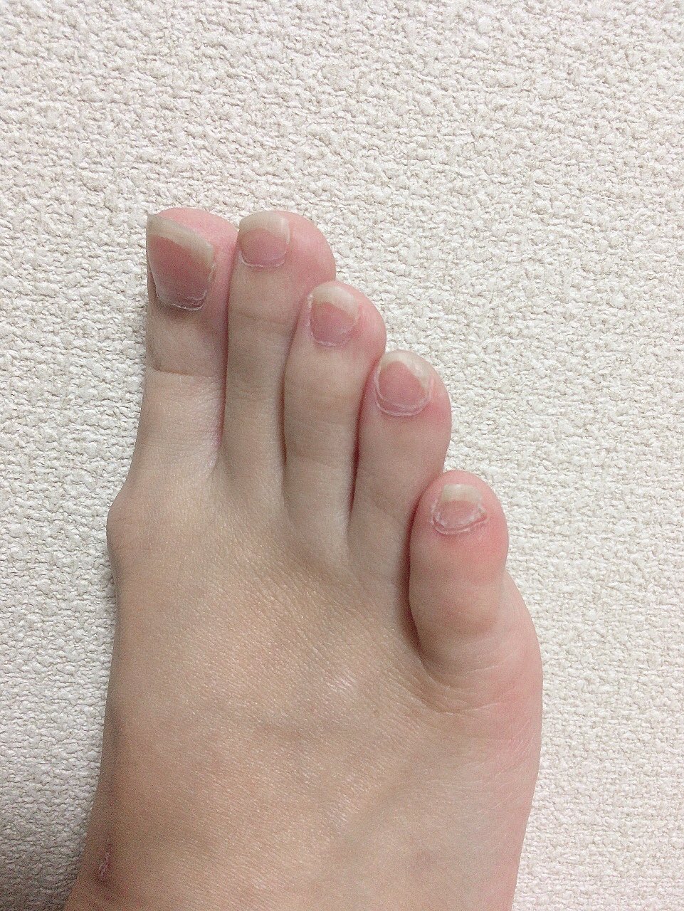 まんねん 汚い足あげてすまぬorz でも聞いてほしい 僕のこの異様に太い足の小指 必ず割れてくる小指の爪 ずっと変だな とは思っていたけど ６本目の指がくっついてるって聞いて ちゃんと爪切りもしてあげてる 前は引っこ抜いてたw 多合趾症っていう