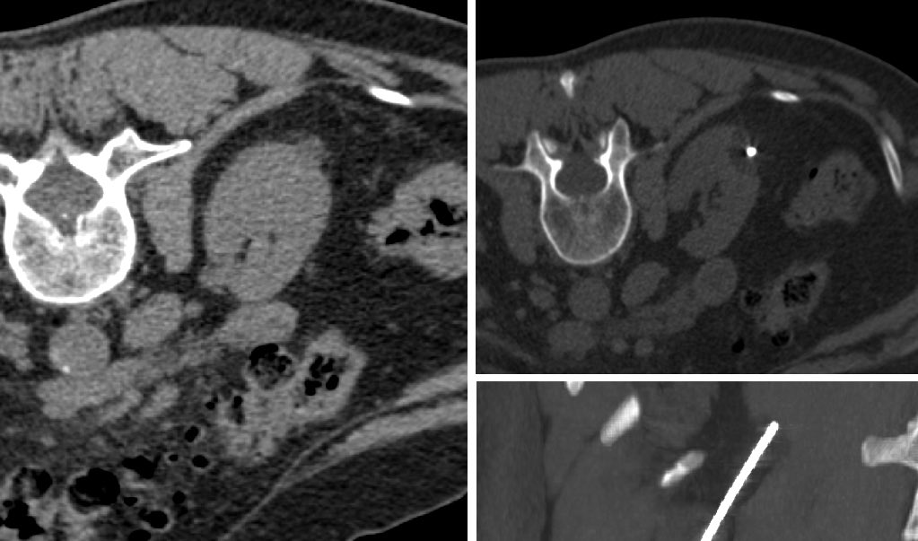 amadabadia's tweet photo. Although most of the time need several cryoprobes to include the lesion within the cryo ball,sometimes a single probe allows us to fully treat a lesion #winningcard @BTGIO @FPuigvert @RodriguezFaba @SERAM_RX @SERVEISoc @Uroweb @JVIRmedia @GeorgiadesMD @SIRspecialists @BSC_Spain https://t.co/SRAMD6RZ7x