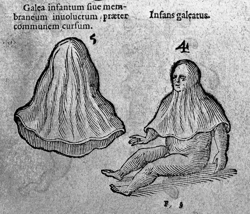Illustration of a caul by Cornelius Gemma, 16th Century. Image @WellcomeCollectionCW: Second image in this thread is a modern photograph of a newborn with a caul in a medical setting where a small amount of blood is visible.