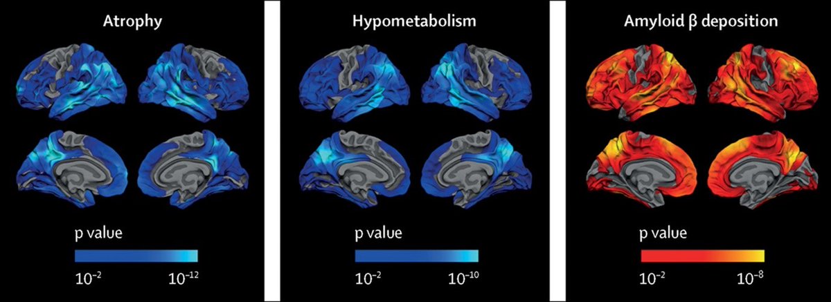 Researchers <a href="/CPFT_NHS/">CPFT</a> <a href="/CIDDRG/">CIDDRG</a> collaborated with <a href="/SantPauMemory/">Sant Pau Memory Unit</a> for 1st time to show in <a href="/TheLancet/">The Lancet</a>  that #Alzheimers disease can develop without clinical symptoms, in people with #Downsyndrome. Now clinical trials need to find treatments &amp; reduce mortality: bit.ly/3eWkOE2