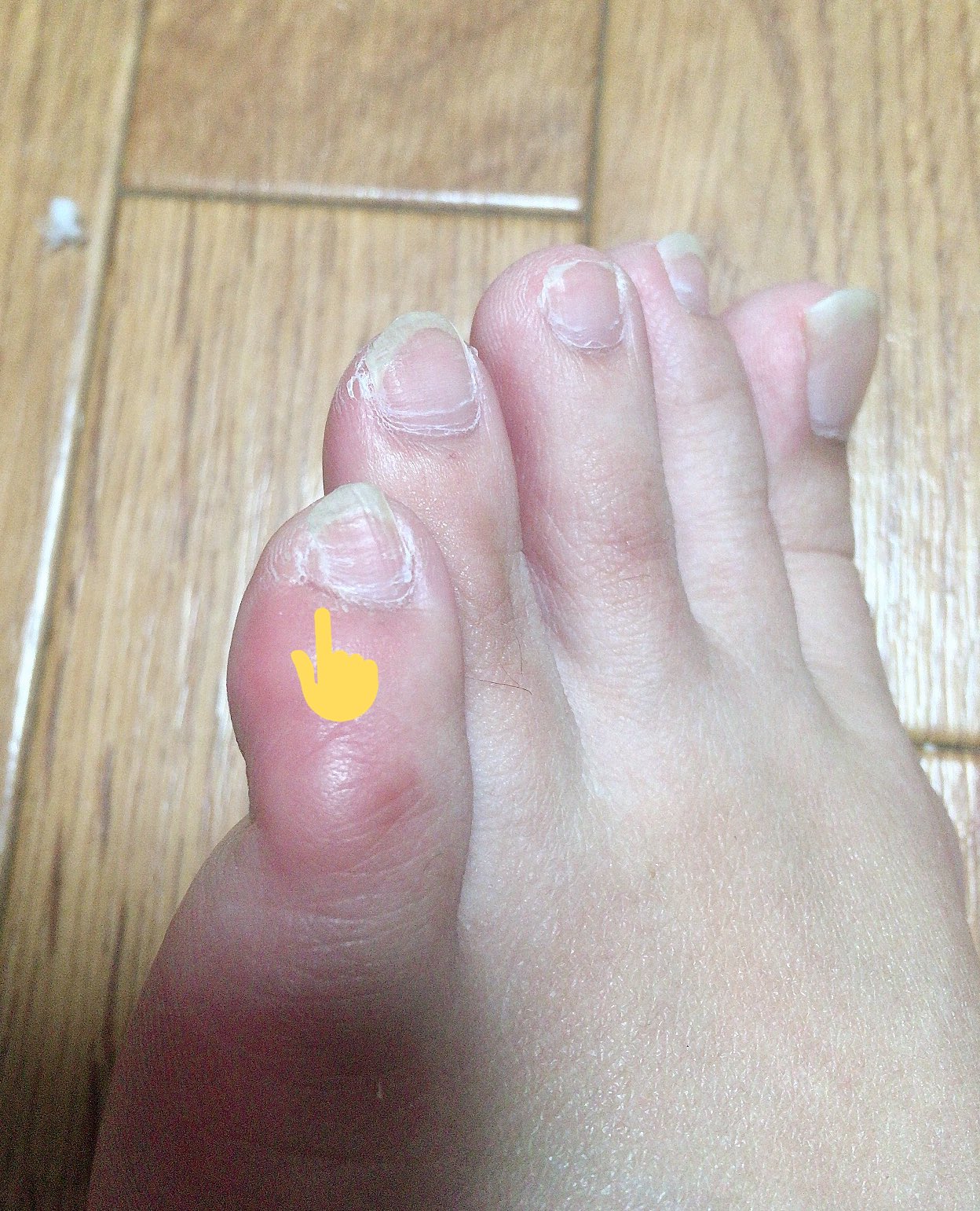 まんねん Mcomplete そうなんですよ 勝手に伸びるので ジェルネイル してもおしのけて生えてきちゃって困ってました こっちの足の方がわかりやすいですね 今はジェルネイルはしていないのですが こまめにやすりをかけてトゲみたいにならないようにし
