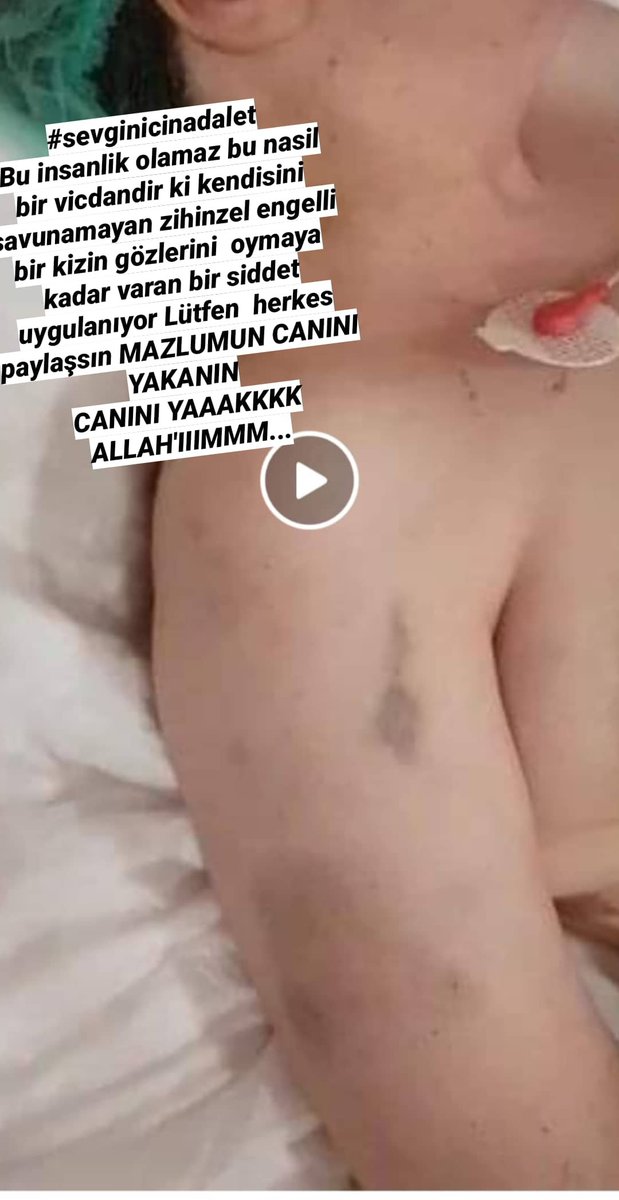 nazanyasarbas's tweet photo. Ben bir otizmli çocuk annesi olarak ben öldükten sonra ne olucak değil bizler ölmeden ne olacaklarına endişeliyim yetkililerimize sesleniyorum sivil toplum kuruluşları ile birlikte çalışmalar yapılsın  @RTErdogan @tcbestepe @drfahrettinkoca @ailevecalisma @ziyaselcuk https://t.co/fiffYmcjF4