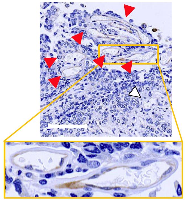 GIRCOR's tweet photo. #Chimiothérapie 💉: la sécrétion d'IL8 après chimio provoque des #inflammations 🔥augmentant le taux d'ABCB1 et crée des anomalies vasculaires et donc une résistance aux médicaments. 😱Inhiber #ABCB1 améliore la thérapie chez la #souris 🐁🤞🧐https://t.co/OyxucWK0vf https://t.co/DcA54jhh0g