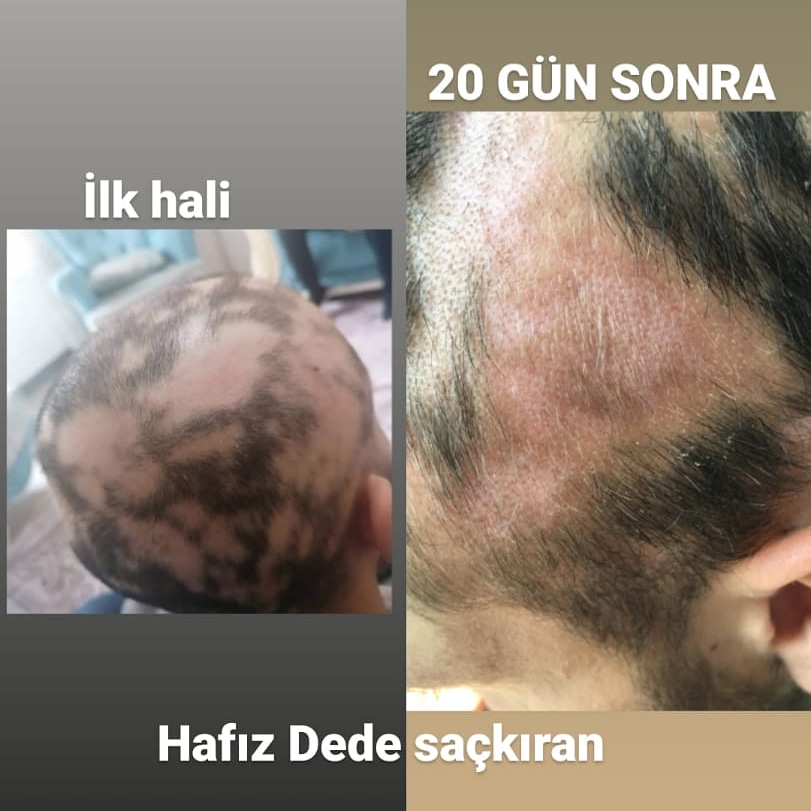 sackiran34's tweet photo. 20 gün önce tedavi ettiğimiz Azad beyin durumu iyi gidiyor çok şükür bugünkü durumu göründüğü gibi Tüylenme başlamış
0532 015 86 31 İstanbul Başakşehir
.
#saçkıran #sakalkiran #sacbakimi #sacekimi #saçsakalkıran #sackirantedavisi #hafizdedesackiran #alopesi #saçkıran #areta https://t.co/BMPNc3nwEW