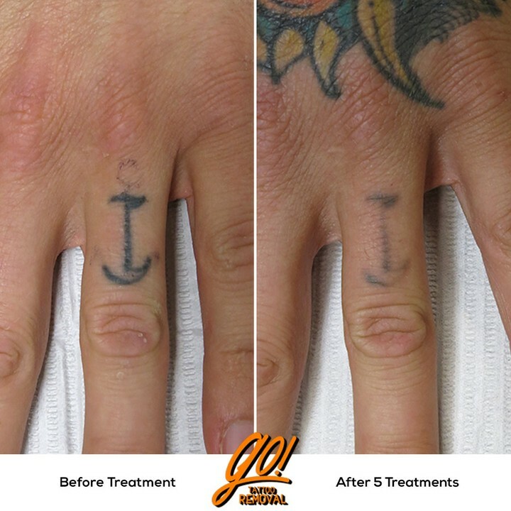 Vol 2 Best Of 2021 Before  After Tattoo Removal Results  Removery