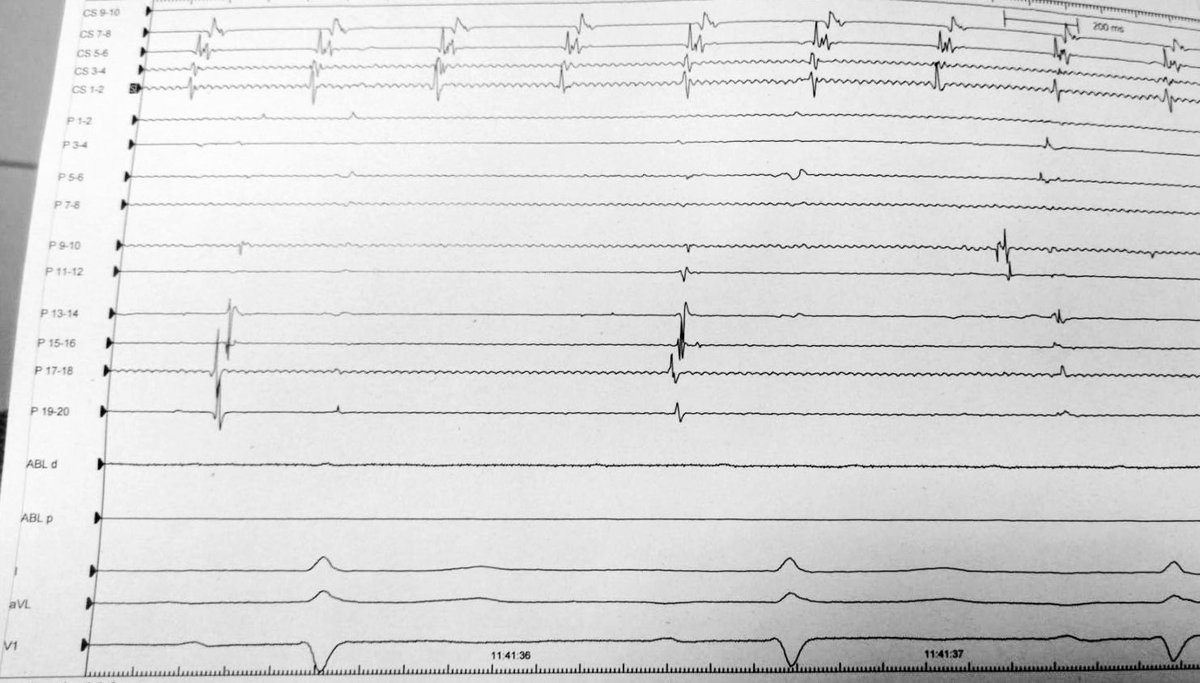 franchin_luca's tweet photo. Temporary interatrial dissociation during #atypical #atrialflutter #ablation. SR in the right atrium vs flutter in the left one.#cardiotwitter #cardioep #Cardiology #electrophysiology #Cardiología https://t.co/fBMTHSiRpz