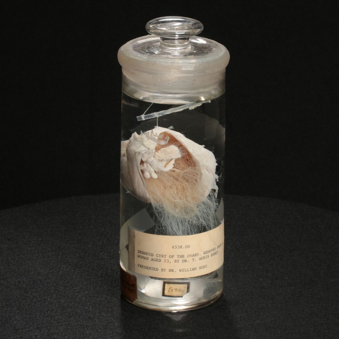 MutterMuseum's tweet photo. Combing through #MementoMutter and came across this teratoma: a tumor made of different bodily tissue, including hair!
Join us on 7/9 for Online Office Hours with the curator. Learn about the hairiest members of the collection. Register now: https://t.co/DweS207Mra https://t.co/6IXINCDJyM