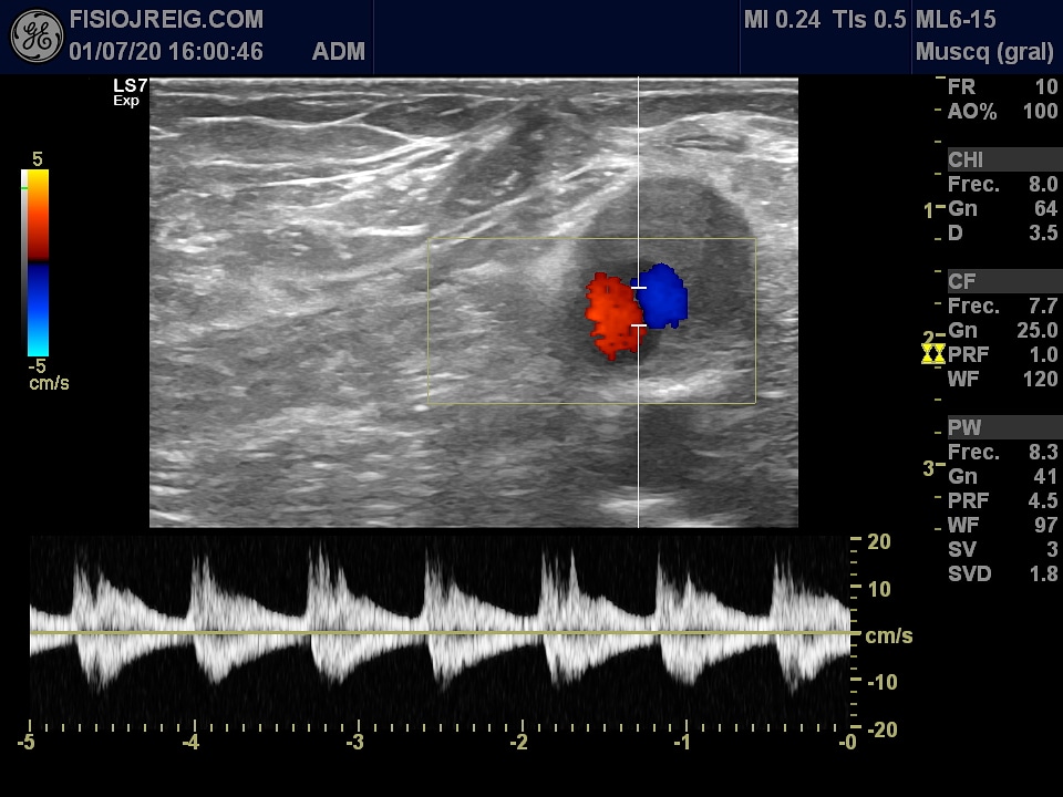 Aneurisma de la arteria femoral!! Cuanta información nos da la #ecografia a la hora de derivar a otros especialistas y saber lo que NO hay que tocar ! <a href="/fisiojreig/">fisiojreig</a> #formacion