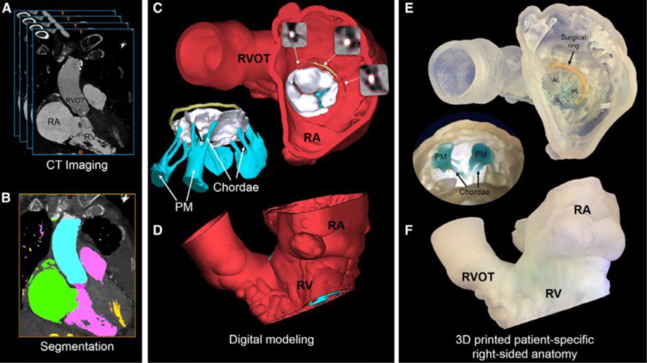 Check out our paper just published in <a href="/CircAHA/">Circulation</a>
"Patient-Specific 3D Printed Modeling of the #Tricuspid Valve for #MitraClip Planning" bit.ly/2NRX3AQ
#CardioTwitter #ACCFIT #TreatTR #EchoFirst #YesCCT <a href="/SLittleMD/">Stephen Little, MD</a> <a href="/NadeenFaza/">Nadeen N. Faza, M.D.</a> <a href="/HeartToProve/">Carlos El-Tallawi, MD “HeartToProve”</a> <a href="/noravenatti/">Nora</a>