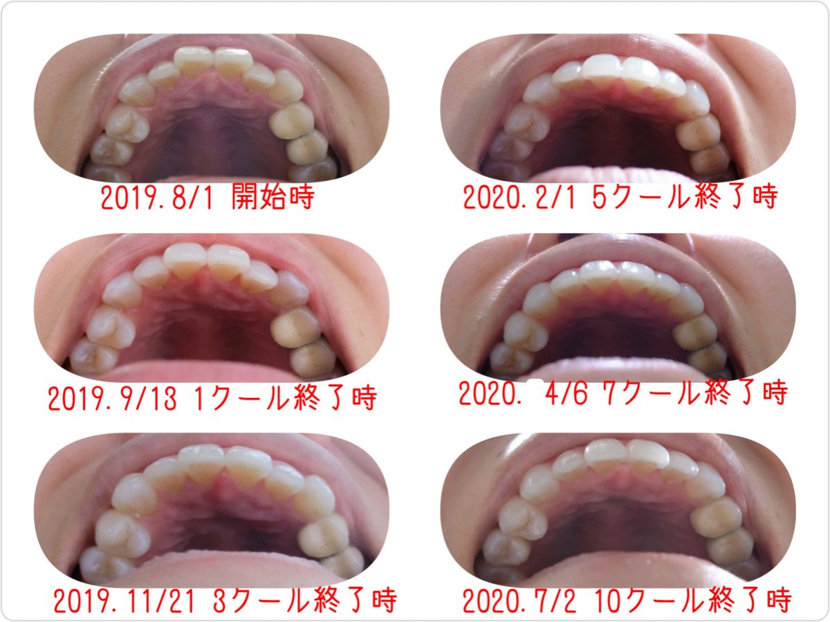 矯正 キレイ ライン