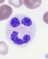 2/It’s not always possible to determine the cause of pancytopenia based on blood smear morphology alone. However, here is a (not comprehensive) list of clues you don’t want to miss: