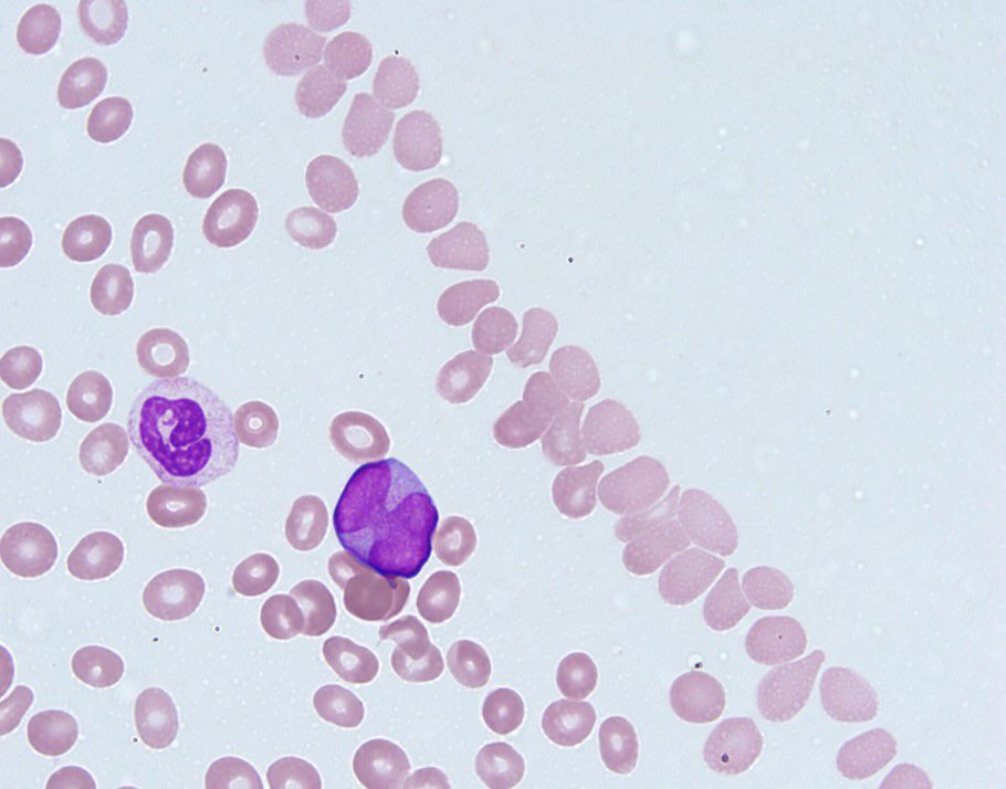 7/Remember that larger cells can be pushed to the periphery of the slide. Check the smear edges to look for rare atypical cells. In this case of acute promyelocytic leukemia, the blasts were rare and only present at the edges of the smear.