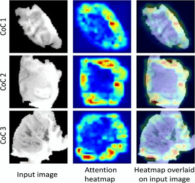 Radiology_AI's tweet image. From the archives... Predicting tumor genomic subtypes in lower-grade gliomas doi.org/10.1148/ryai.2… @budamat @ebadawy_ @DukeRAILabs #TBT #radiogenomics #LGG