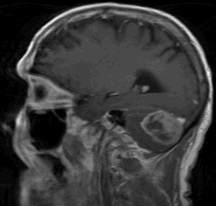 drshamikc's tweet photo. A new era for neurosurgery in Queens, NY: @MohsenNouriMD @AmritChiluwalMD and I treated this sick gentleman with a large brain tumor in his cerebellum @JamaicaHospital. With our fantastic staff, it went smoothly! Thanks to @drdavidlanger and @LenoxNeurosurg for making it possible https://t.co/yZ91fDHbuo