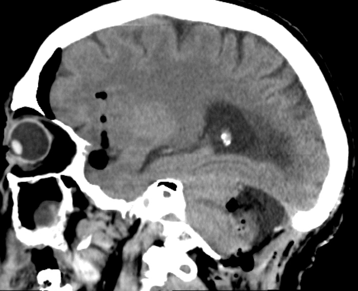 drshamikc's tweet photo. A new era for neurosurgery in Queens, NY: @MohsenNouriMD @AmritChiluwalMD and I treated this sick gentleman with a large brain tumor in his cerebellum @JamaicaHospital. With our fantastic staff, it went smoothly! Thanks to @drdavidlanger and @LenoxNeurosurg for making it possible https://t.co/yZ91fDHbuo