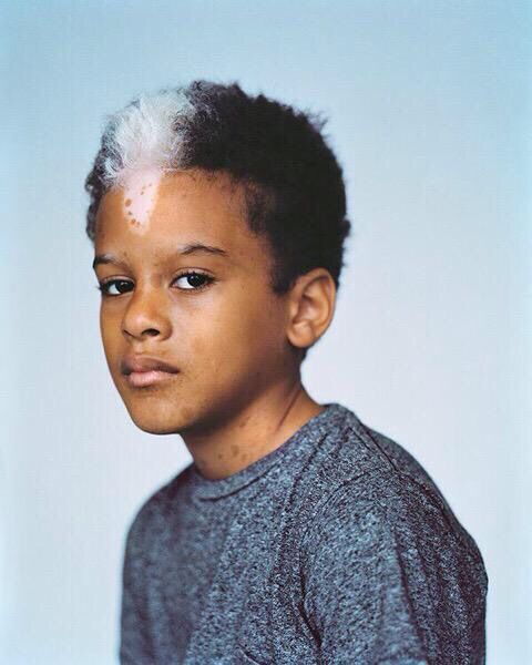 Vitiligo is a long-term skin condition characterized by patches of the skin losing their pigment. The patches of skin affected become white and usually have sharp margins. The hair from the skin may also become white.