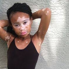 What triggers VITILIGO ?Vitiligo is caused by the lack of a pigment called melanin in the skin. Melanin is produced by skin cells called melanocytes, and it gives your skin its colour. In vitiligo, there are not enough working melanocytes to produce enough melanin in your skin.