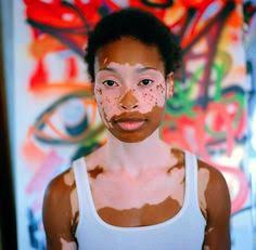 Is VITILIGO a genetic disease?Is vitiligo hereditary? Yes, vitiligo has a genetic basis, although less than half of those with vitiligo know of someone in their family who also has it. If you have vitiligo, it does not necessarily follow that your children will develop it.