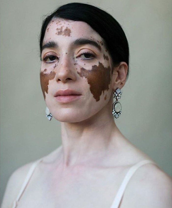 Can VITILIGO be sexually transmitted?This is the common myth about vitiligo. BUT It is not contagious and cannot spread from touching, saliva, inhalation, blood, sexual intercourse or sharing of personal items (drinking bottle, towels).