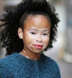What happens if VITILIGO is left untreated?Pigment may occasionally return, but usually the white patches continue to spread, and if left untreated, may involve extensive areas of the skin. Vitiligo doesn't itch or hurt, and most people with the condition are generally HEALTHY