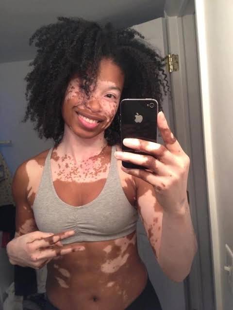 What happens if VITILIGO is left untreated?Pigment may occasionally return, but usually the white patches continue to spread, and if left untreated, may involve extensive areas of the skin. Vitiligo doesn't itch or hurt, and most people with the condition are generally HEALTHY