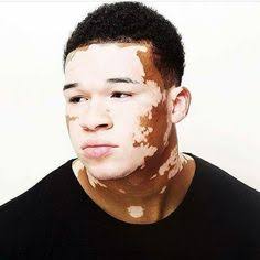 How do you stop VITILIGO from spreading?Topical steroids come as a cream or ointment you apply to your skin. They can sometimes stop the spread of the white patches and may restore some of your original skin colour.