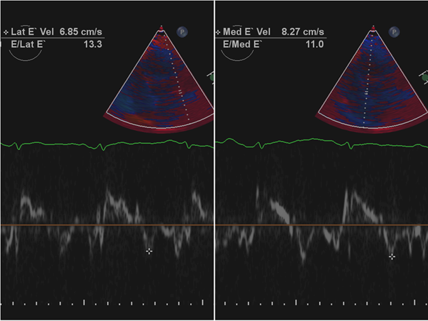 4/ In restriction, tissue Doppler is abnormal (e' and  E/e') but in constriction e' is preserved and often higher in the septal annulus rather than lateral which can be tethered by the thickened pericardium ("annulus reversus" or "annulus paradoxus") as seen in our case.