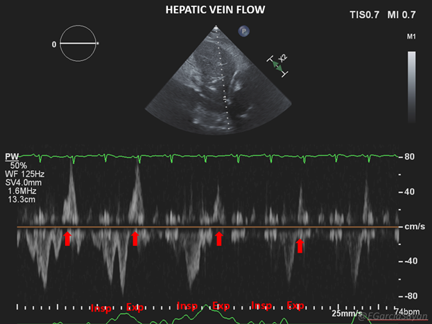 5/ PWD of the hepatic veins (HV) reveals expiratory diastolic flow reversal in both CP and CT. This is due to LV interdependence and septum shifting to the R in expiration, not allowing RV to fully expand in diastole. Demonstrated here (respirometer tracing not great, sorry...).