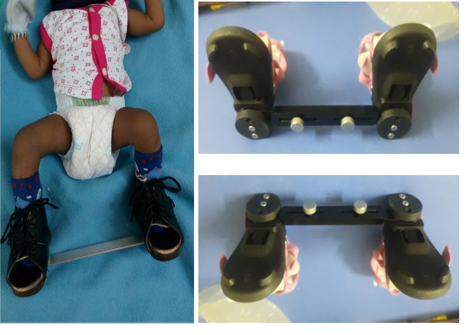 Creative Op Solution Club Foot Shoes Without Bar Shoes For Clubfoot Toddlers Clubfoot Shoes Online Clubfoot Shoes In India Club Foot Shoes Price In India Clubfoot Ctev Clubfootshoe Clubfootsplint Ponsettisplint