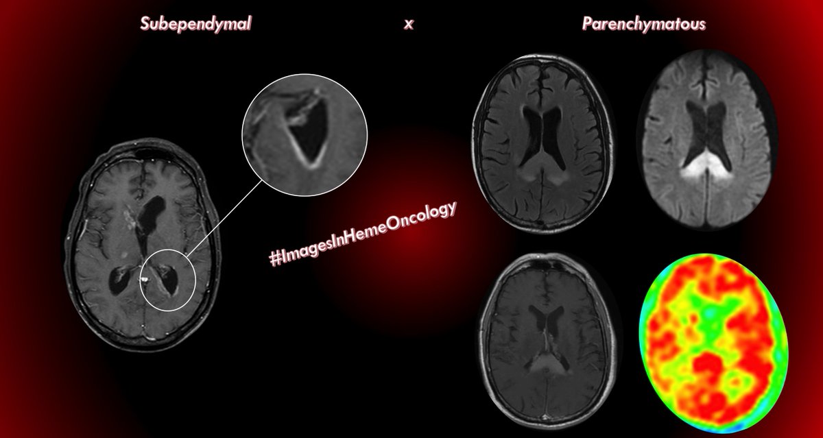 #ImagesInHemeOncology 01 – CNS secondary infiltration
Just to remember 2 frequent types of CNS infiltration in case of prophylaxis has failed.
Subependymal x Intraparenchymatous.
On MRI due to hypercelullarity...
T2/FLAIR hypointensity
Restricted diffusion
Homogeneous enhancement