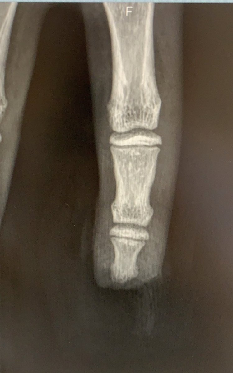 moncaillou_12's tweet photo. J’ai quand même entendu l’IDE demander au patient si il « voulait récupérer le bout de son doigt en souvenir » 😂😂😂 https://t.co/gOvSQfeGkl