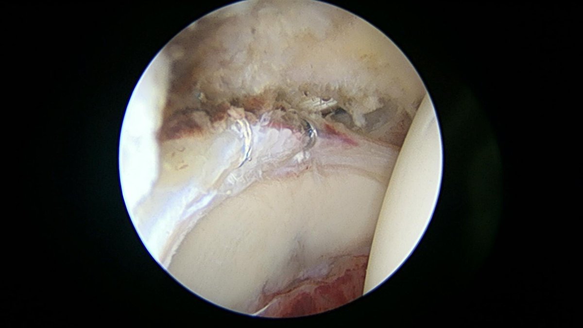 CzarneckiMD's tweet photo. Hip labral tear in this case occurred after an injury with underlying pincer and cam impingement. We first identify the tear, then remove the pincer; then stabilize the labrum; finally we remove the cam impingement #hiplabralrepair #hiparthroscopy https://t.co/RX7uN0qywV