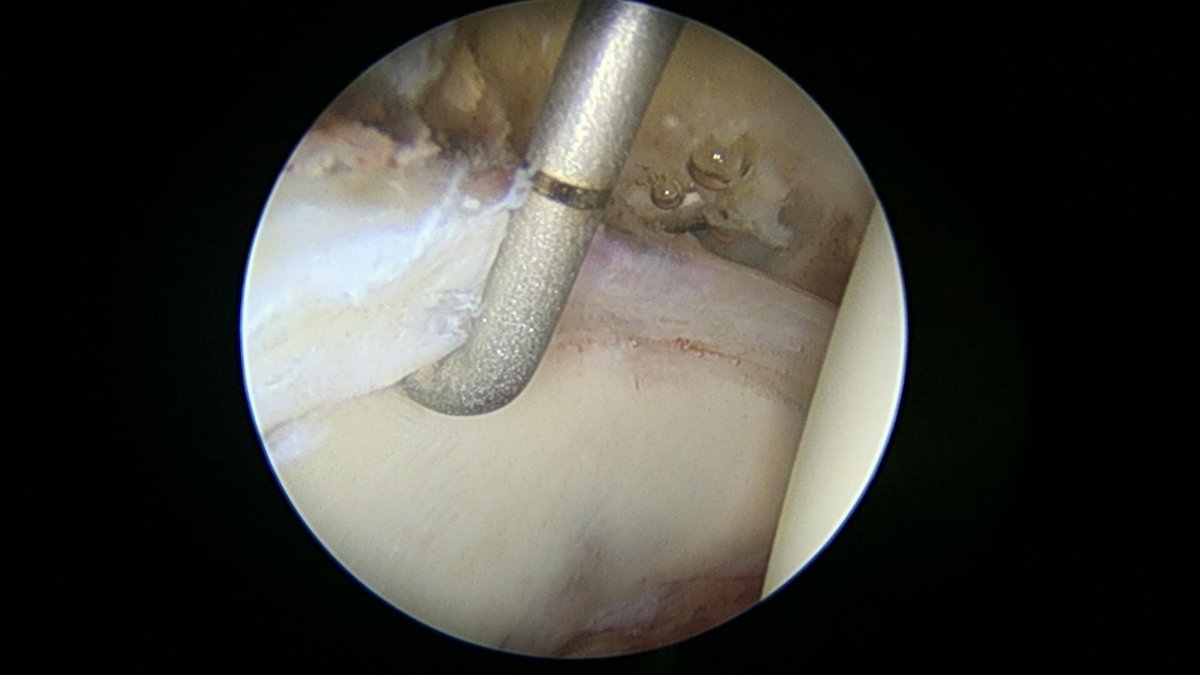 CzarneckiMD's tweet photo. Hip labral tear in this case occurred after an injury with underlying pincer and cam impingement. We first identify the tear, then remove the pincer; then stabilize the labrum; finally we remove the cam impingement #hiplabralrepair #hiparthroscopy https://t.co/RX7uN0qywV