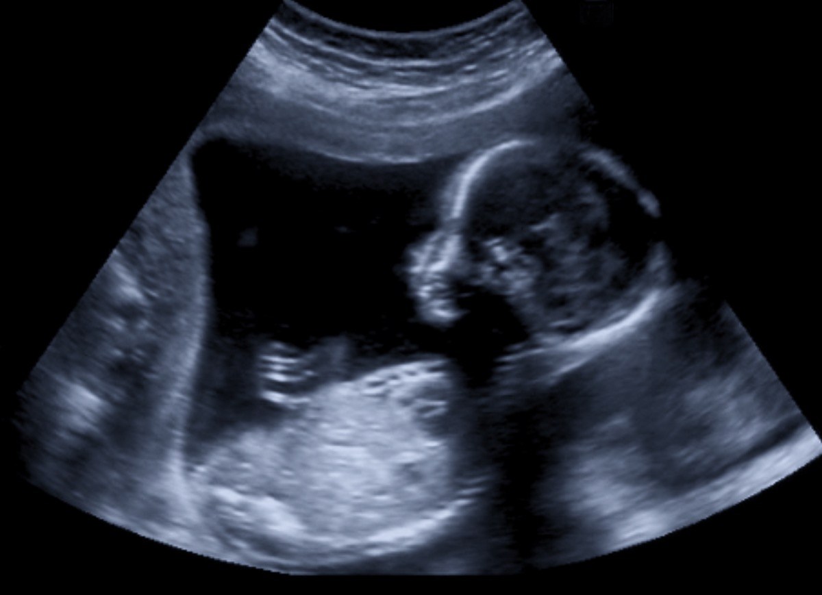 FlowLabsCA's tweet image. Guess what? Male babies can get erections in the womb.!

From as early as 16 wks, fetuses have been observed with protuberances. The Los Angeles Times reported that periodic movements are necessary to help the penile tissue stay healthy.