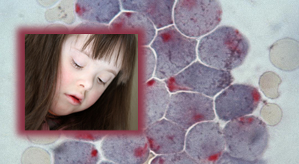  #HematologyTweetstory 27: “Down syndrome in Down House.” This story, based on a  @BloodJournal article I wrote in 2005, sits at the intersection of history, hematology, and evolutionary biology. (Image of girl with trisomy 21 and AML blasts is from “Cancer Therapy Advisor”.) /1