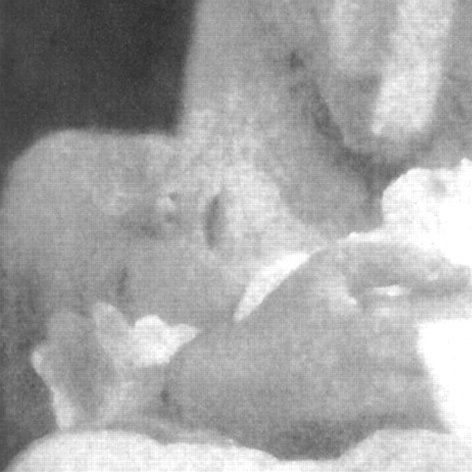 From early on, it was clear that the Darwins' last infant was not “normal”. There was no name yet in 1856 for his condition (more on that below). The grainy, underdeveloped picture is far from definitive, but reveals *possible* facial features of trisomy 21. But there's more./10