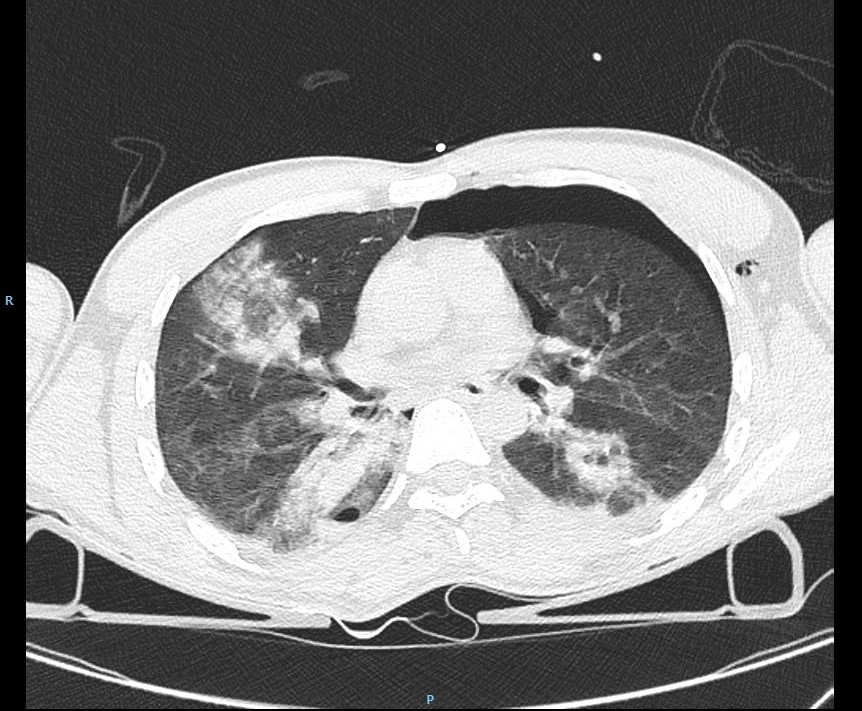 vale_chiarini's tweet photo. Is there anybody out there using #esophagealpressure in chest trauma? Did you have tips &amp; tricks to share?

#transpulmonarypressure #respiratorycare #chesttrauma @HamiltonMedical #nutrivent #optivent #FOAMcc #FOAMtrauma @TraumaUpdate https://t.co/LD0wKz6pni