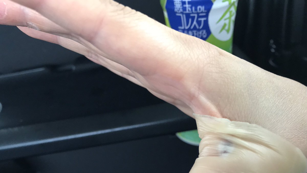 Hami Ma いい感じ 昨日のズキズキ痛いはヒリヒリ痛いに けど 何故か親指の付け根から手首が痛い 雨だから腱鞘炎の名残り出てるのかな ドアノブとか回すのもここ当たって痛いから しばらく左手をメインで使用 鉛筆はふうわり持てば大丈夫そうだから